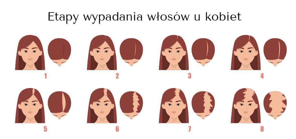 etapy wypadania wlosow u kobiet etapy wypadania wlosow u kobiet