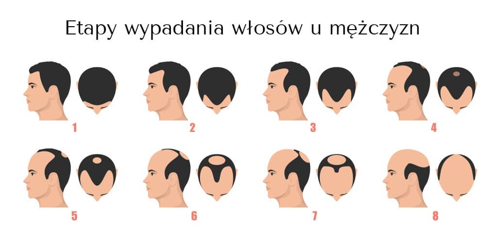 etapy wypadania wlosow u mezczyzn etapy wypadania wlosow u mezczyzn