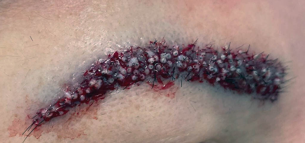 przeszczep brwi przeszczep brwi