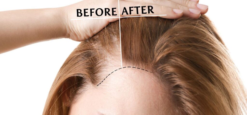 przeszczep włosów u kobiet