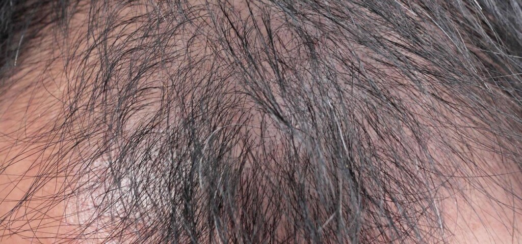 androgenowe łysienie u mężczyzny androgenowe łysienie u mężczyzny