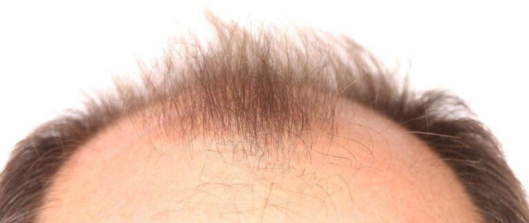 leczenie lysienia e1549396571973