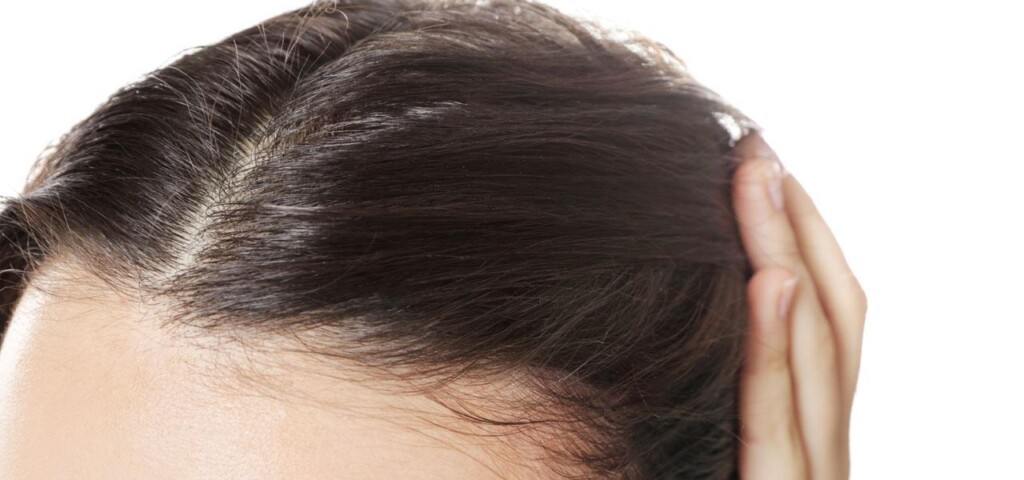 łysienie androgenowe u kobiet łysienie androgenowe u kobiet