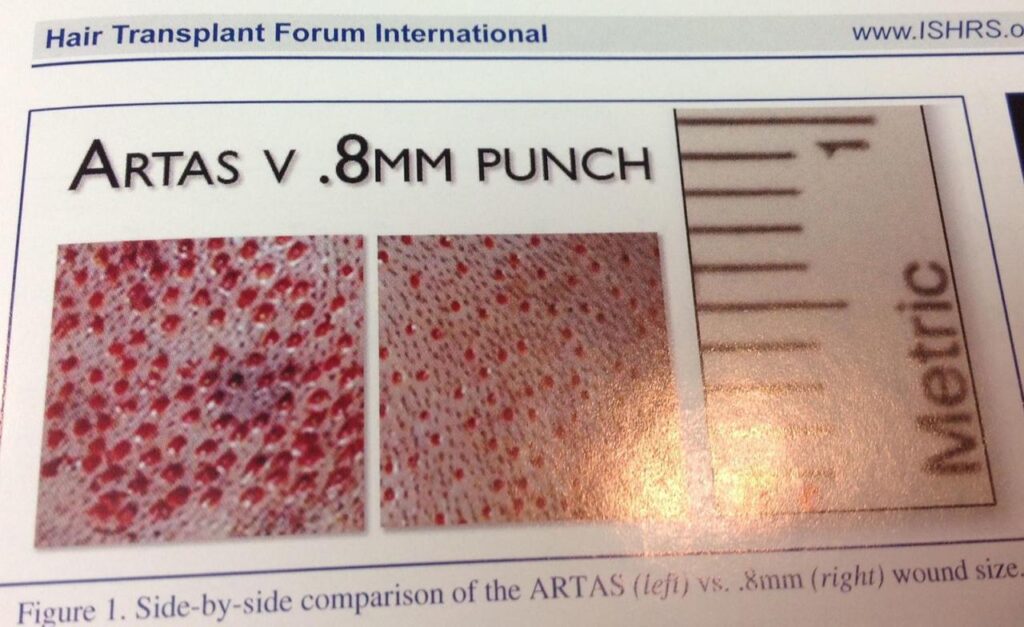 Przeszczep włosów metodą Artas