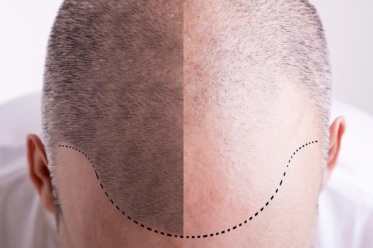 Hair transplant ARTAS or FUE: What is the best method?