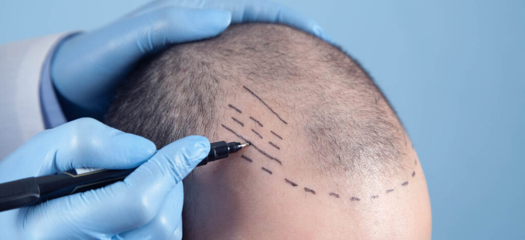Doctor marking hairline before hair transplant