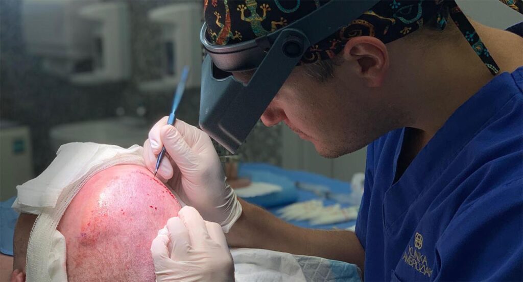 przeszczep włosów metodą artas czy fue