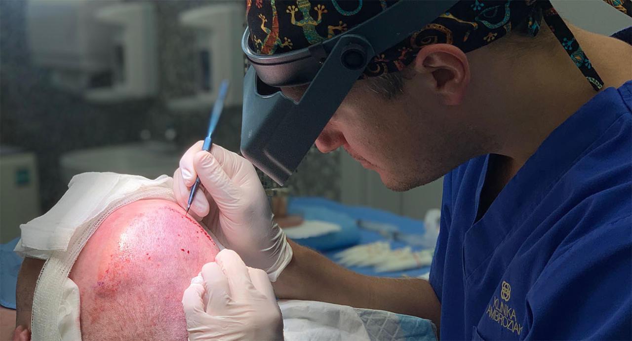 ARTAS czy FUE – jaką metodę przeszczepu włosów wybrać?