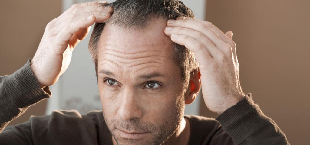 widoczne zakola u mężczyzny