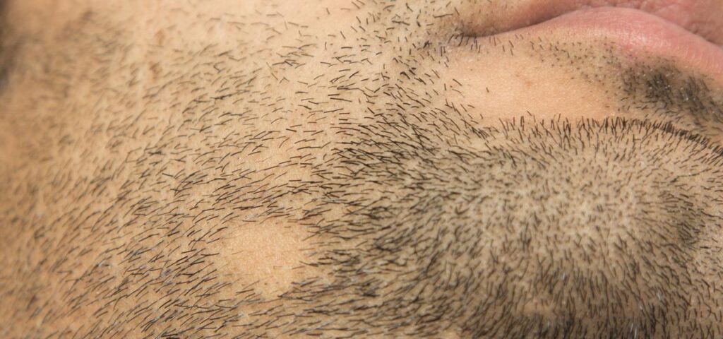 Łysienie plackowate na brodzie