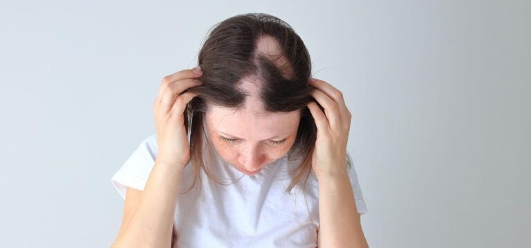 lysienie plackowate u kobiety