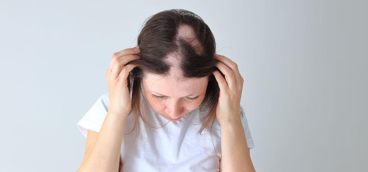 Łysienie plackowate – przyczyny, odmiany, metody leczenia