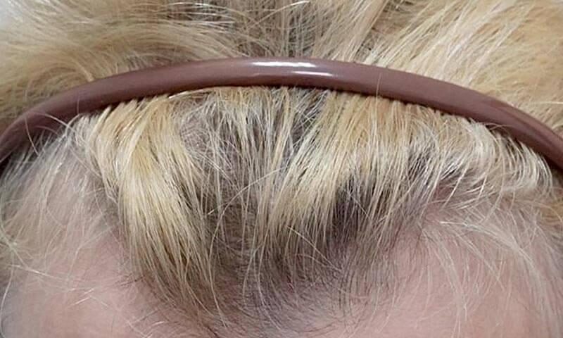 Widoczne zakola u kobiety