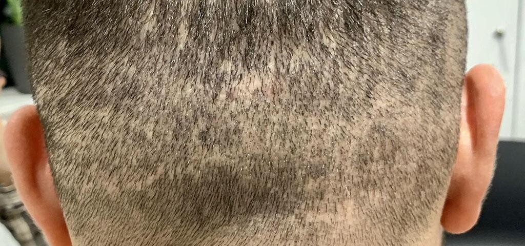 Efekt nieudanego przeszczepu włosów w Turcji