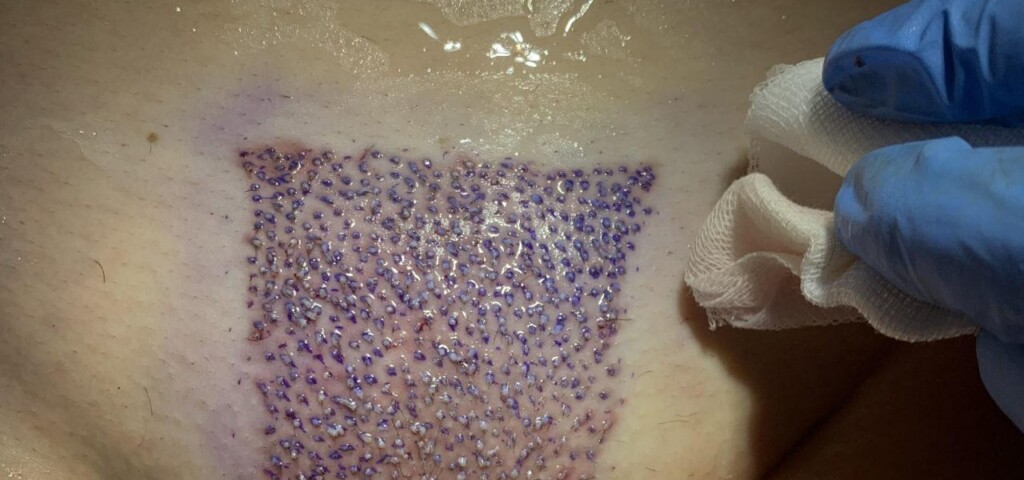 przeszczep włosów okolice bikini przeszczep włosów okolice bikini