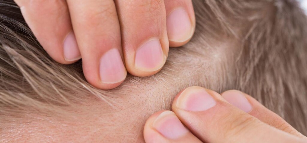 Łojotokowe zapalenie skóry głowy