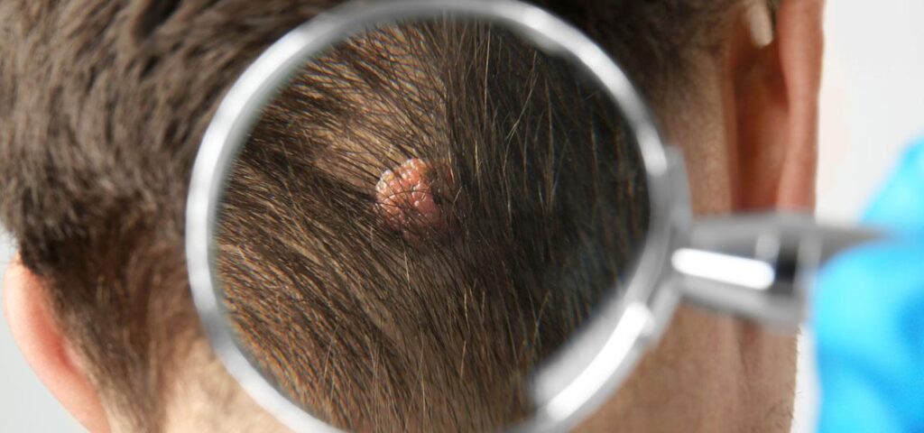 Krosty i strupy na glowie