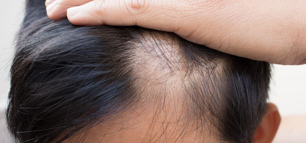 Łysienie bliznowaciejące – przyczyny, objawy i leczenie