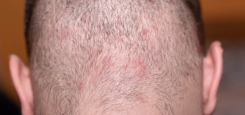 krosty na głowie krosty na głowie