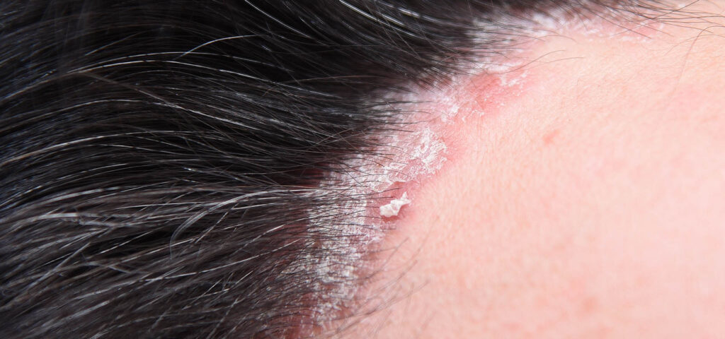 strupy na głowie - łuszczyca