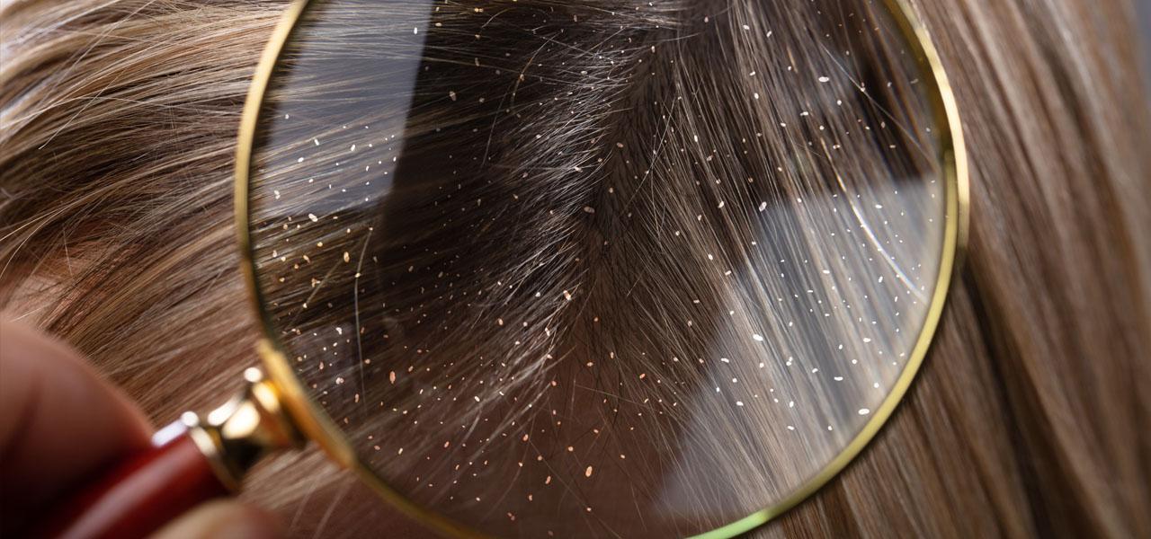 Łupież suchy – jak wygląda i jak się go pozbyć