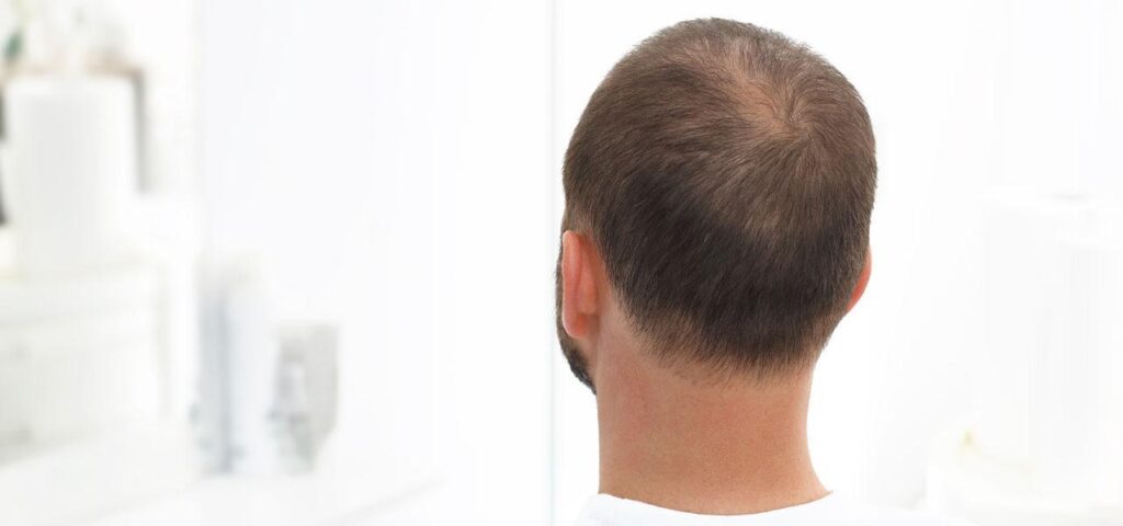 Łysienie telogenowe