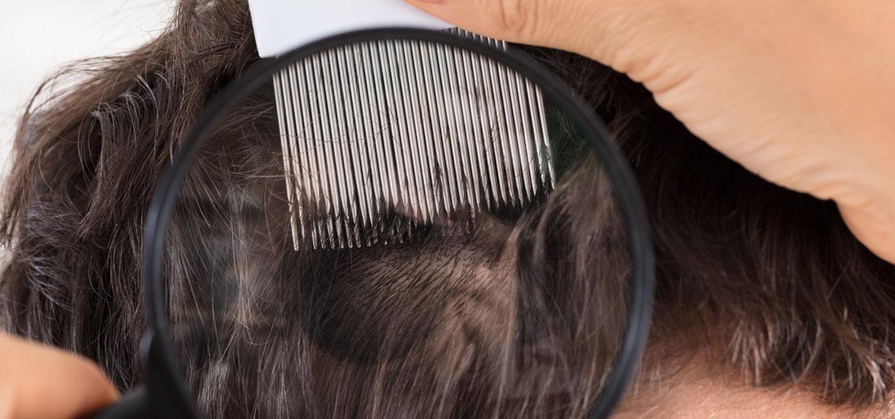 3 najpopularniejsze choroby skóry głowy