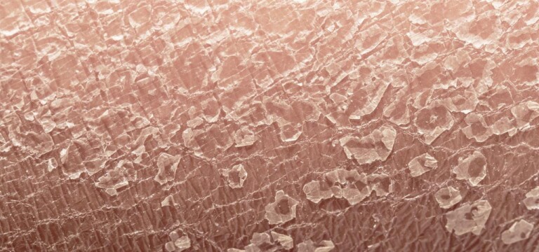 Łuszczyca skóry głowy