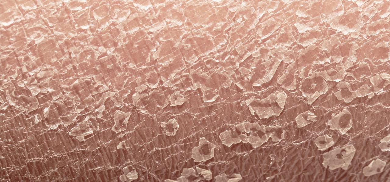 Łuszczyca skóry głowy – przyczyny, objawy, leczenie