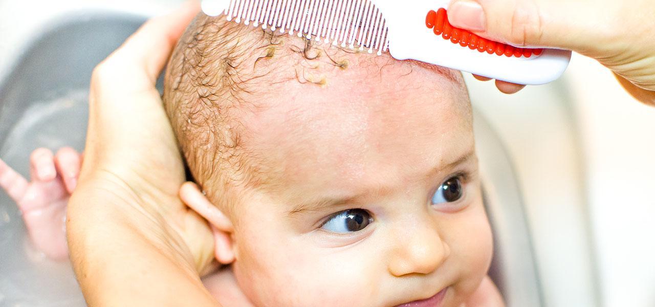 Ciemieniucha u dzieci – przyczyny, objawy, leczenie