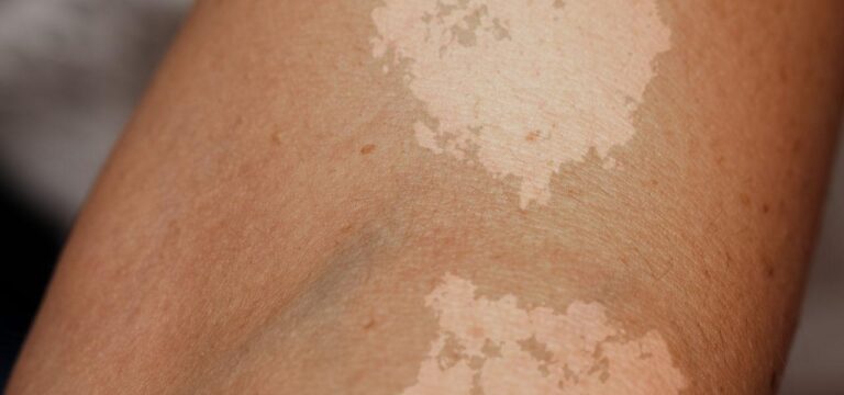 lupiez pstry na dloni