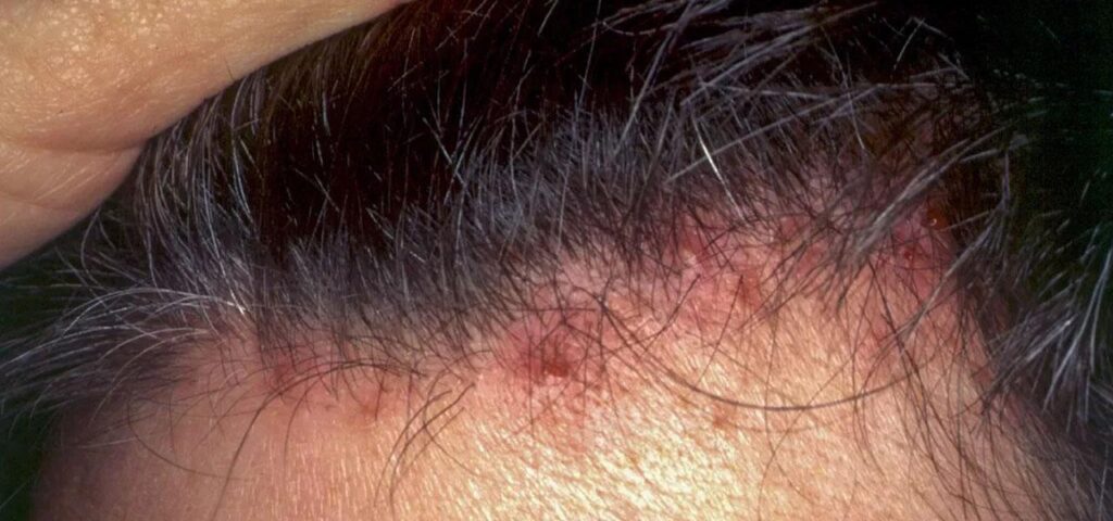 Zapalenie mieszków włosowych
