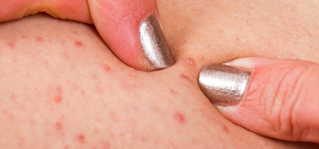 Zapalenie mieszków włosowych