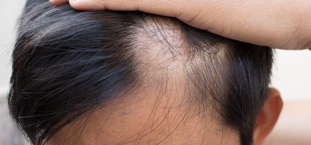 przerzedzone włosy