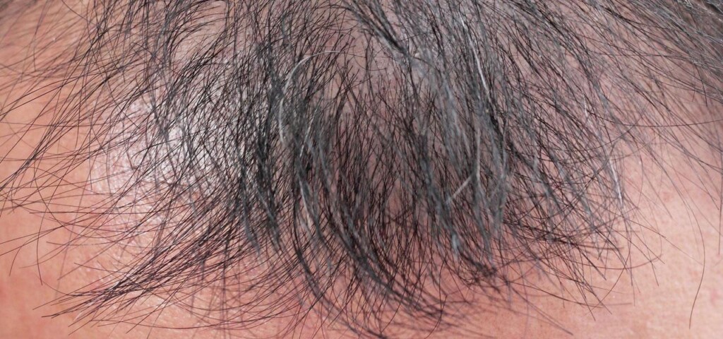 przerzedzone włosy na czubku głowy przerzedzone włosy na czubku głowy