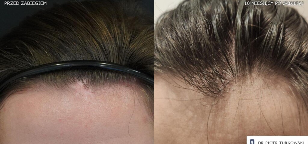 300 grafts hair transplant on a scar