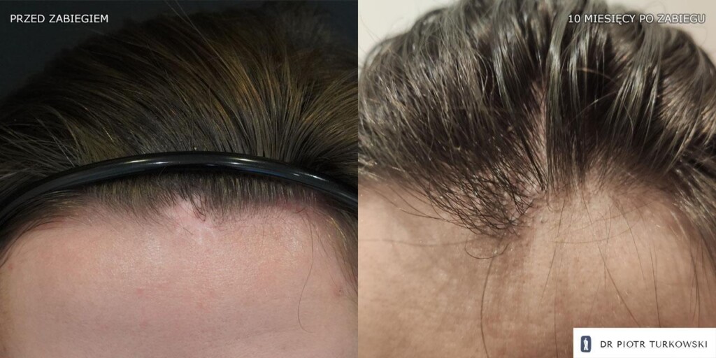 przeszczep włosów na bliznę 300 graftów
