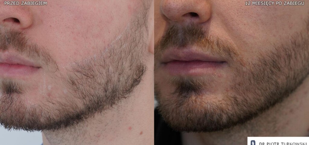 przeszczep brody 1100 graftów