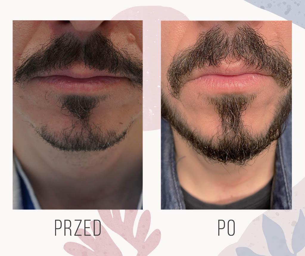 800 graftów na brodę