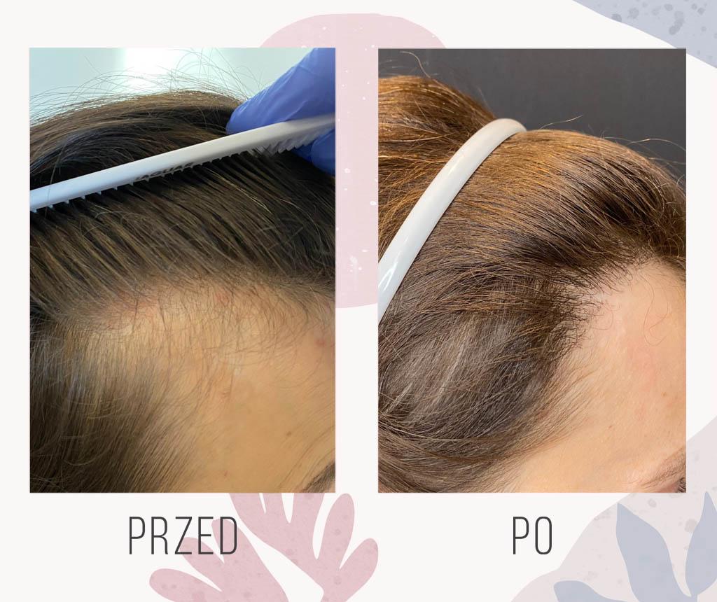 efekt przeszczepu włosów u kobiety - 1600 graftów efekt przeszczepu włosów u kobiety - 1600 graftów