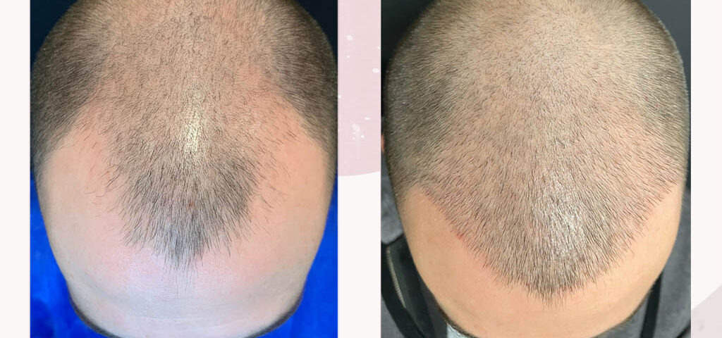 2736 grafts result