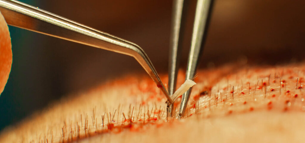 pobranie mieszków włosowych do transplantacji