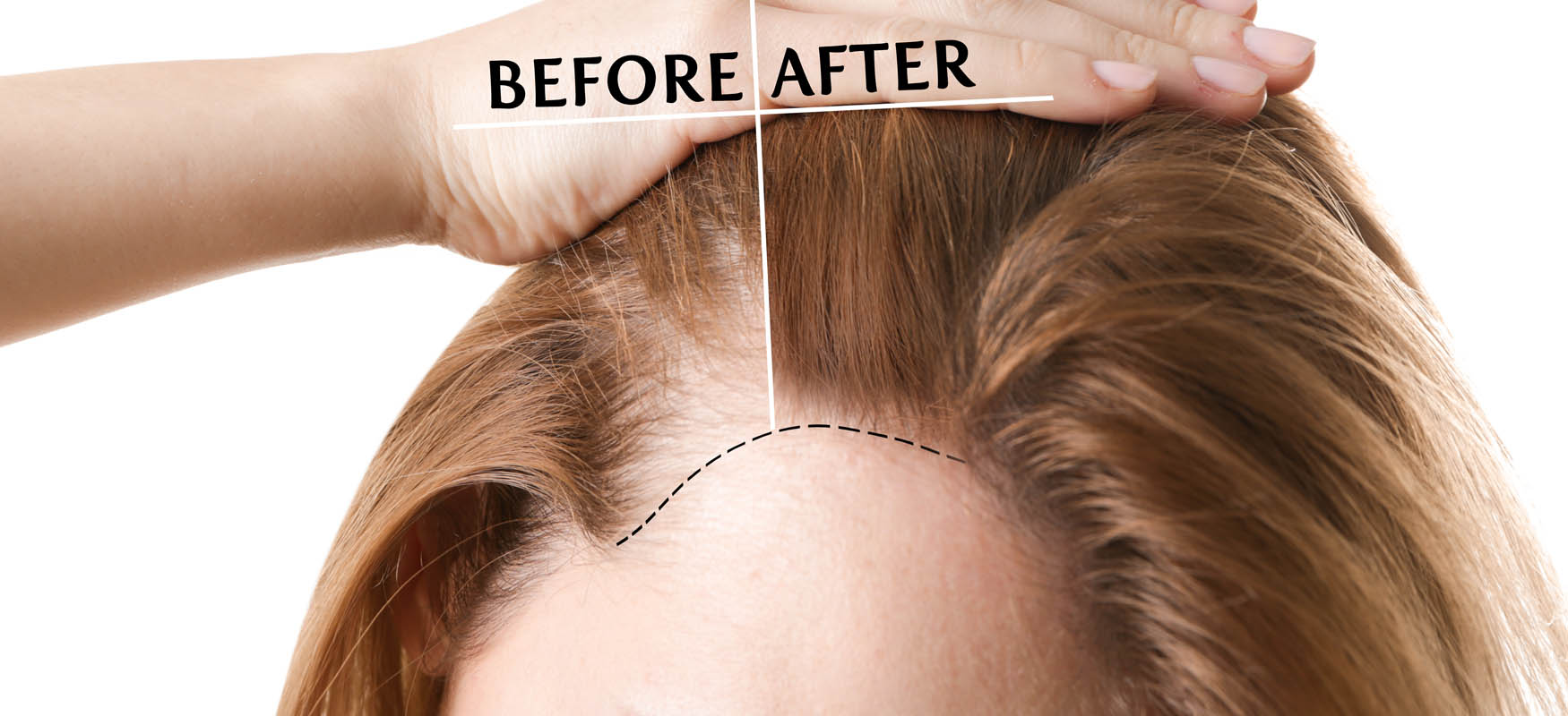 Przeszczep włosów bez golenia włosów