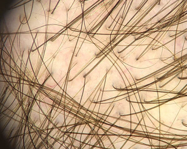 Trichoskopie-Ergebnis Trichoskopie-Ergebnis