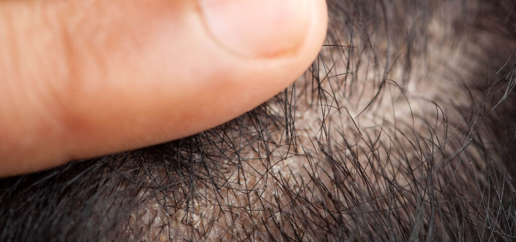 łysienie łojotokowe