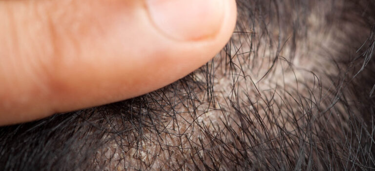 łysienie łojotokowe