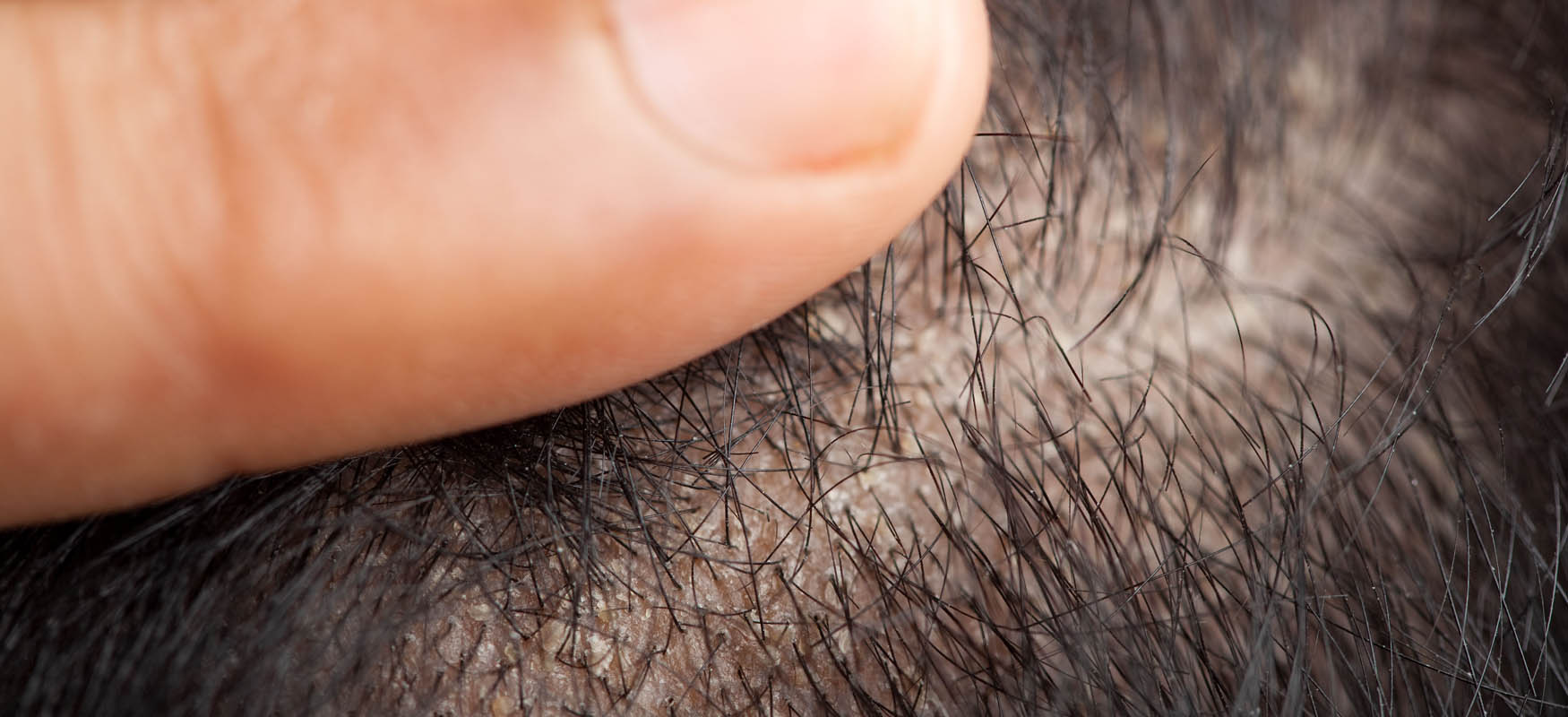 Łysienie łojotokowe. Objawy, przyczyny, leczenie