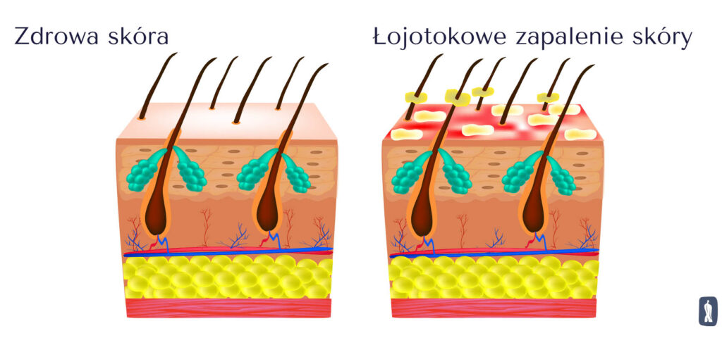 przyczyna łysienia łojotokowego