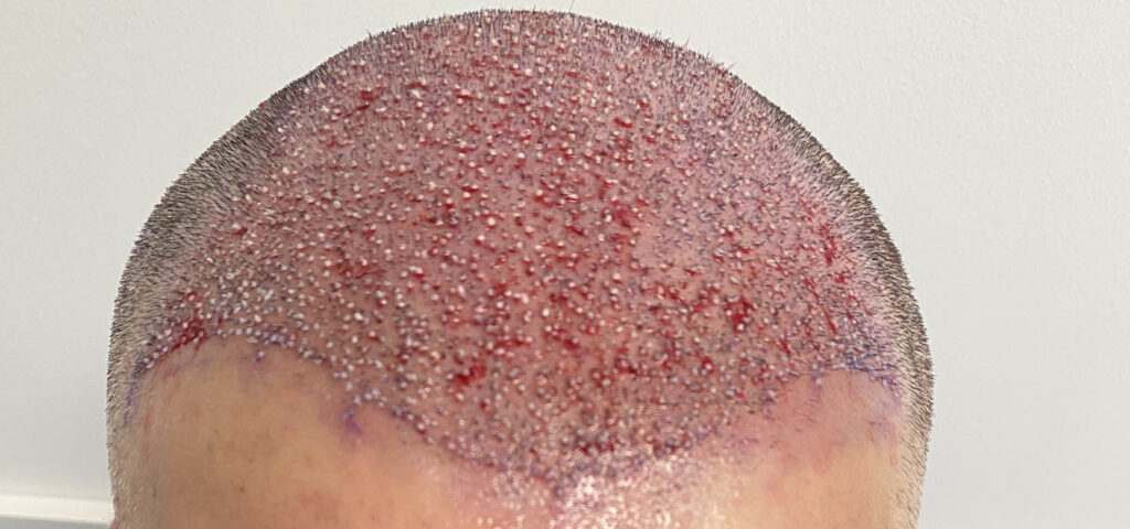 efekt zaraz po zabiegu wszczepiania graftów