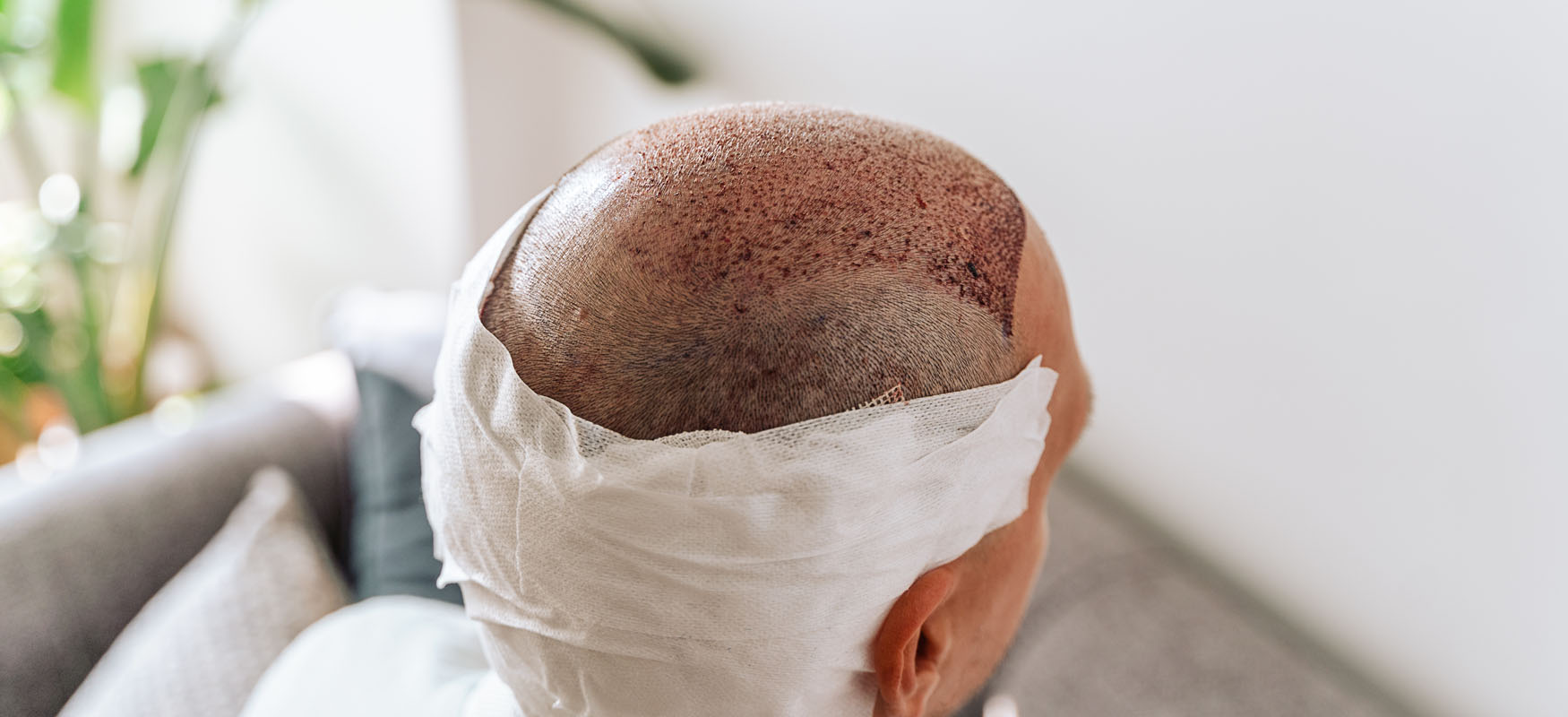 Jak dbać o włosy po przeszczepie?